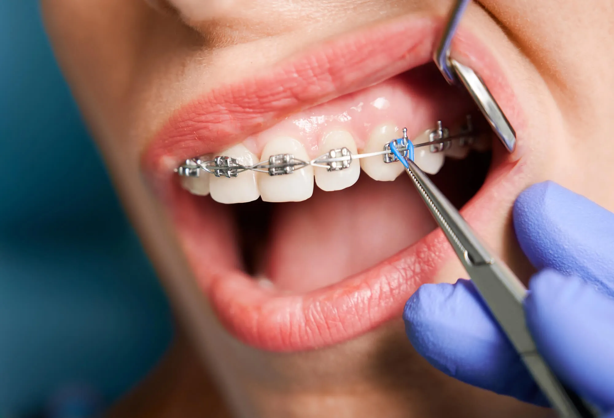 patient-chose-braces-over-Invisalign-Denville-NJ