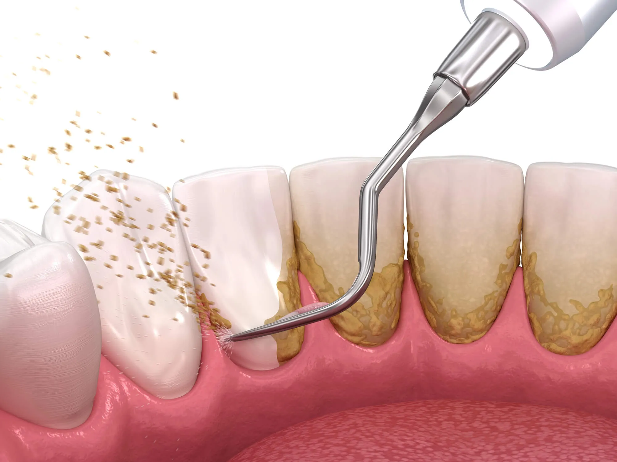 How Plaque Forms and Why Regular Cleanings Matter