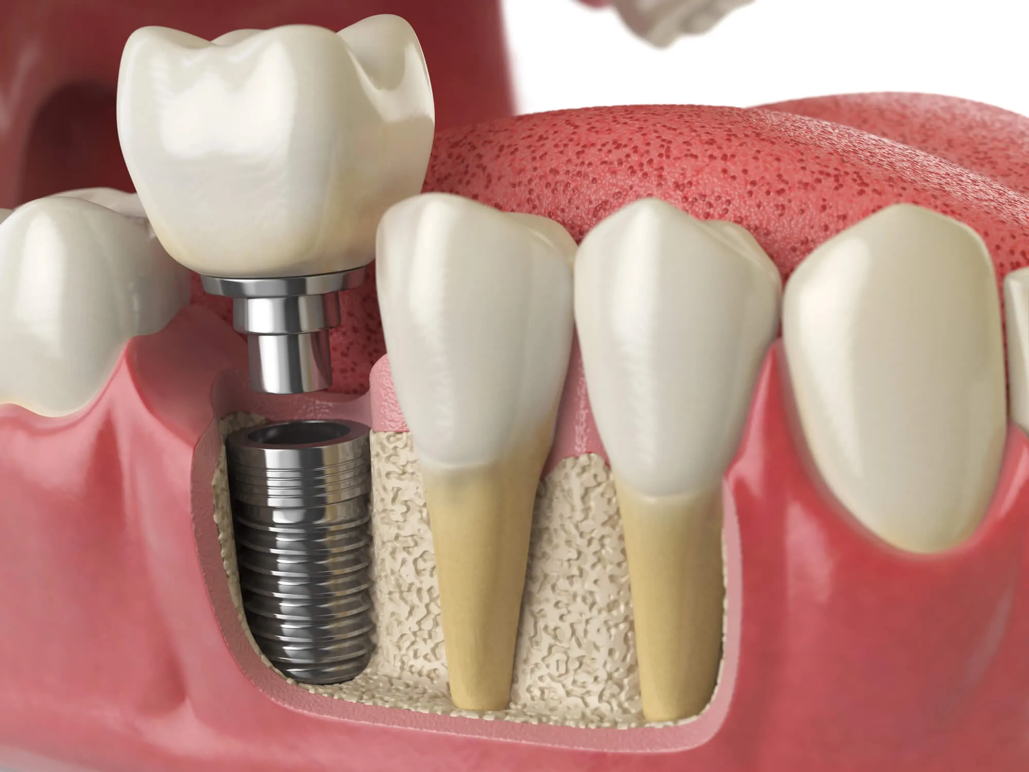 How Long Do Implant Crowns Last?