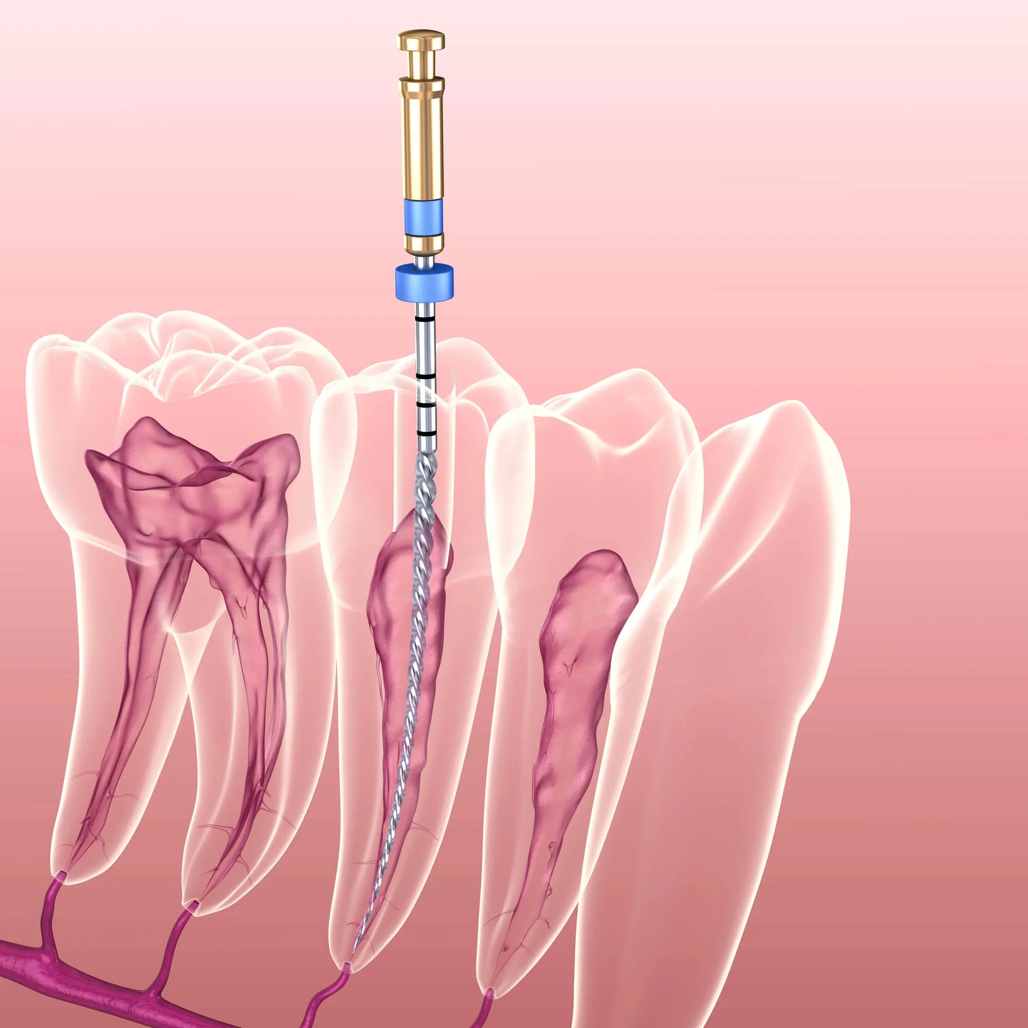 Signs You May Need a Root Canal
