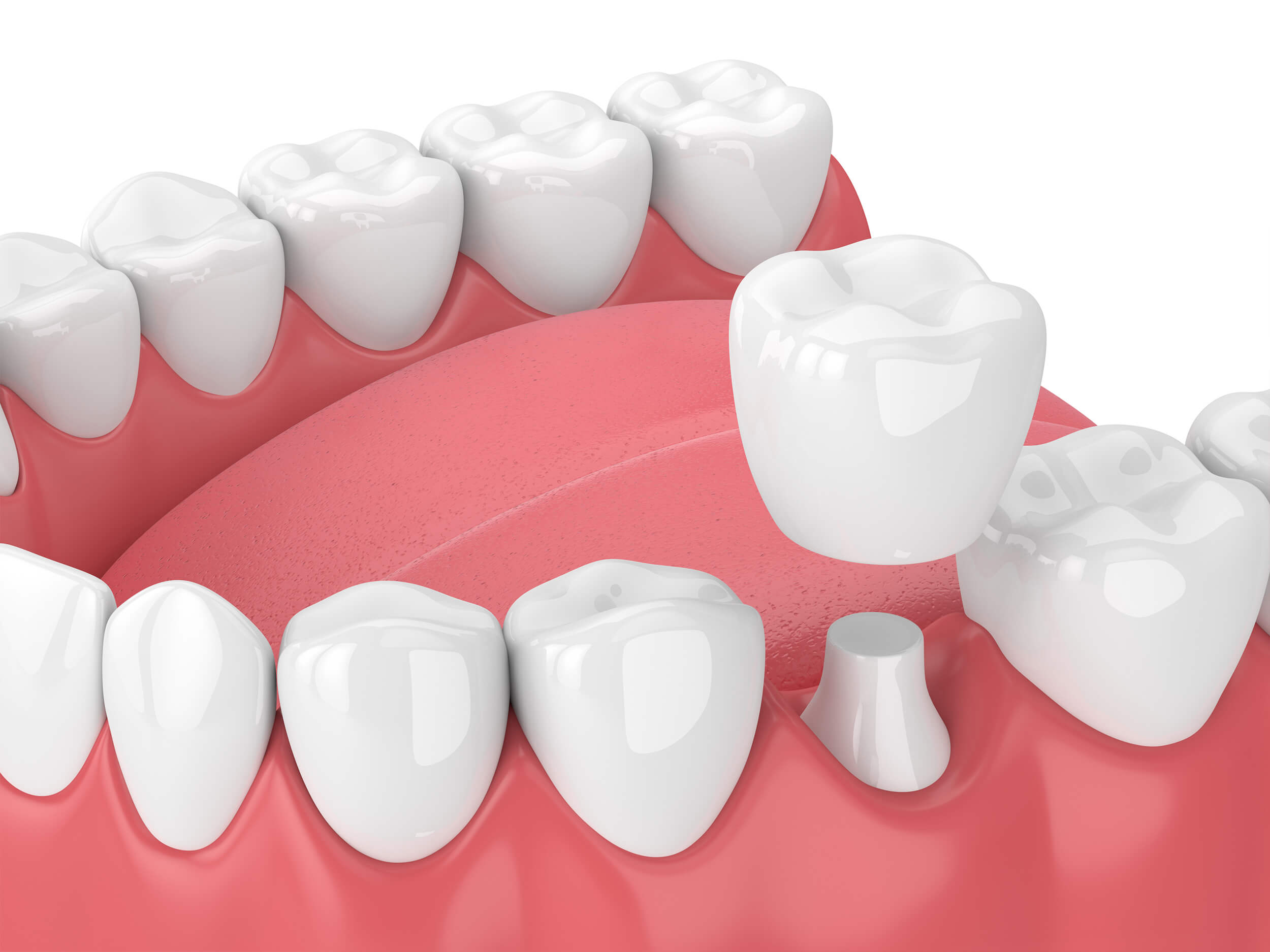 Dental Crowns in Denville, New Jersey